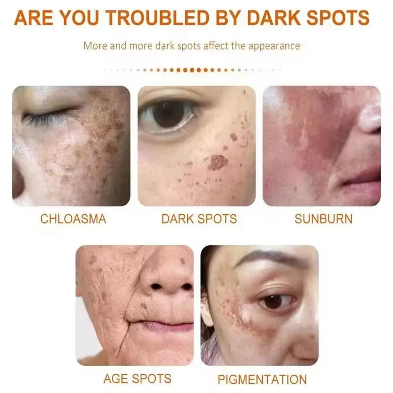 Whitening Freckle Cream Face Brightening Cream Niacinamide Reduce Chloasma Melasma Melanin Fade Fine Lines Lighten Dark Skincare