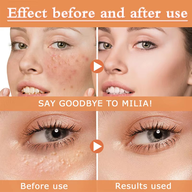 Fat Granules Removal Eye Serum anti Dark Circle Eye Bags Fade Fine Line Essence Anti-Puffiness Moisturizing Skin Care Products