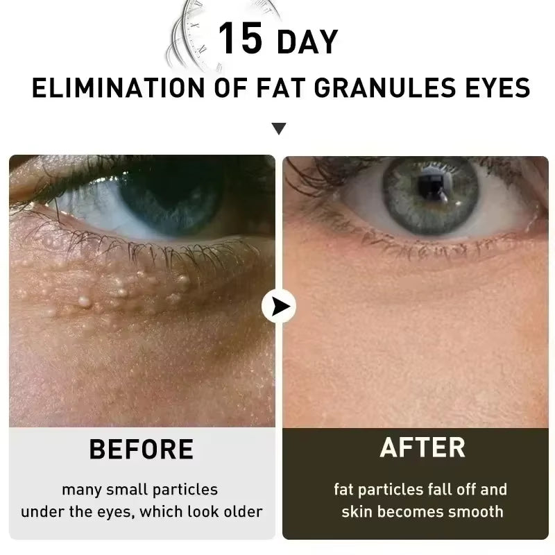 Eye Fat Granules Removal Eyestick Anti-Puffiness Firming Cream anti Inflammatory Fade Fine Line Repair Skin Barrier Skin Care