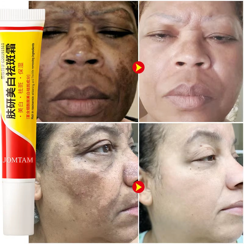 Whitening Freckle Cream Face Brightening Cream Niacinamide Reduce Chloasma Melasma Melanin Fade Fine Lines Lighten Dark Skincare
