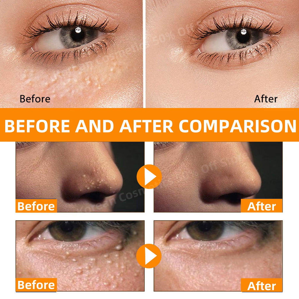 Fat Granules Removal Eye Serum anti Dark Circle Eye Bags Fade Fine Line Essence Anti-Puffiness Moisturizing Skin Care Products